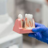 Are Dental Implants Right for You? Find Out in Exeter