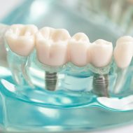 The Dental Implant Procedure in Exeter: Step-by-Step